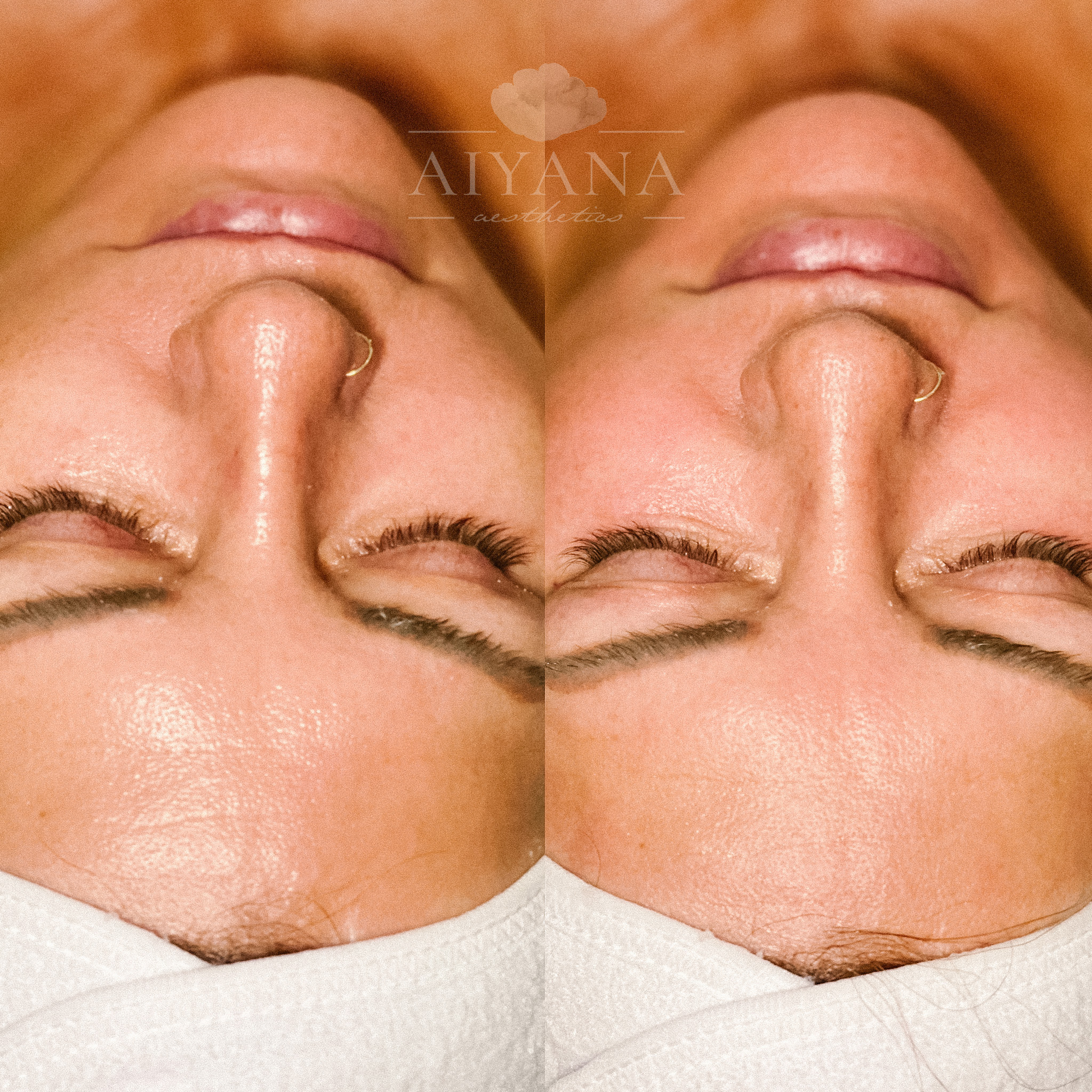 Microneedling | AIYANA Aesthetics
